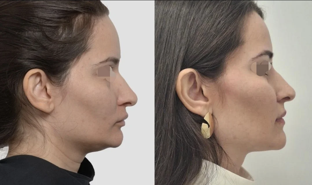 Comparativo antes e depois, vista de perfil, de paciente real
