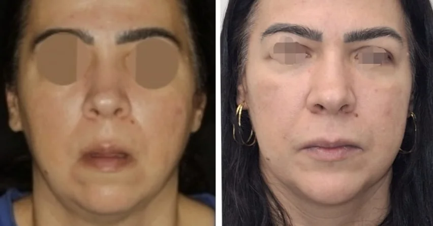 Comparativo antes e depois, vista de perfil, de paciente real
