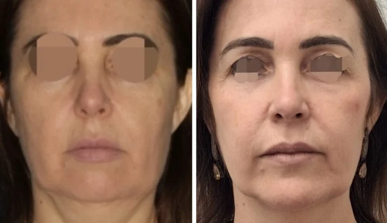 Comparativo antes e depois, vista frontal, de paciente real