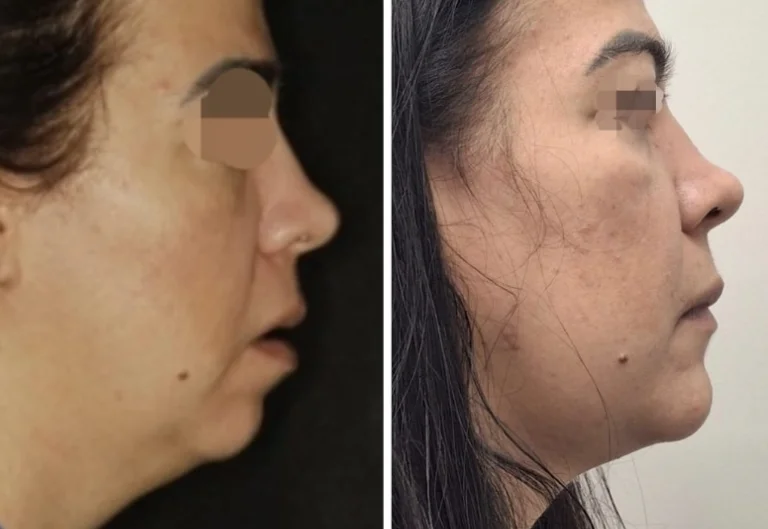 Comparativo antes e depois, vista frontal, de paciente real
